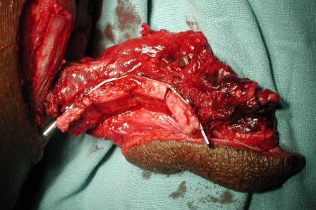 Figure 6: Intraoperative photograph showing the ostoeootmised fibula adapted to the prebent reconstruction plate.